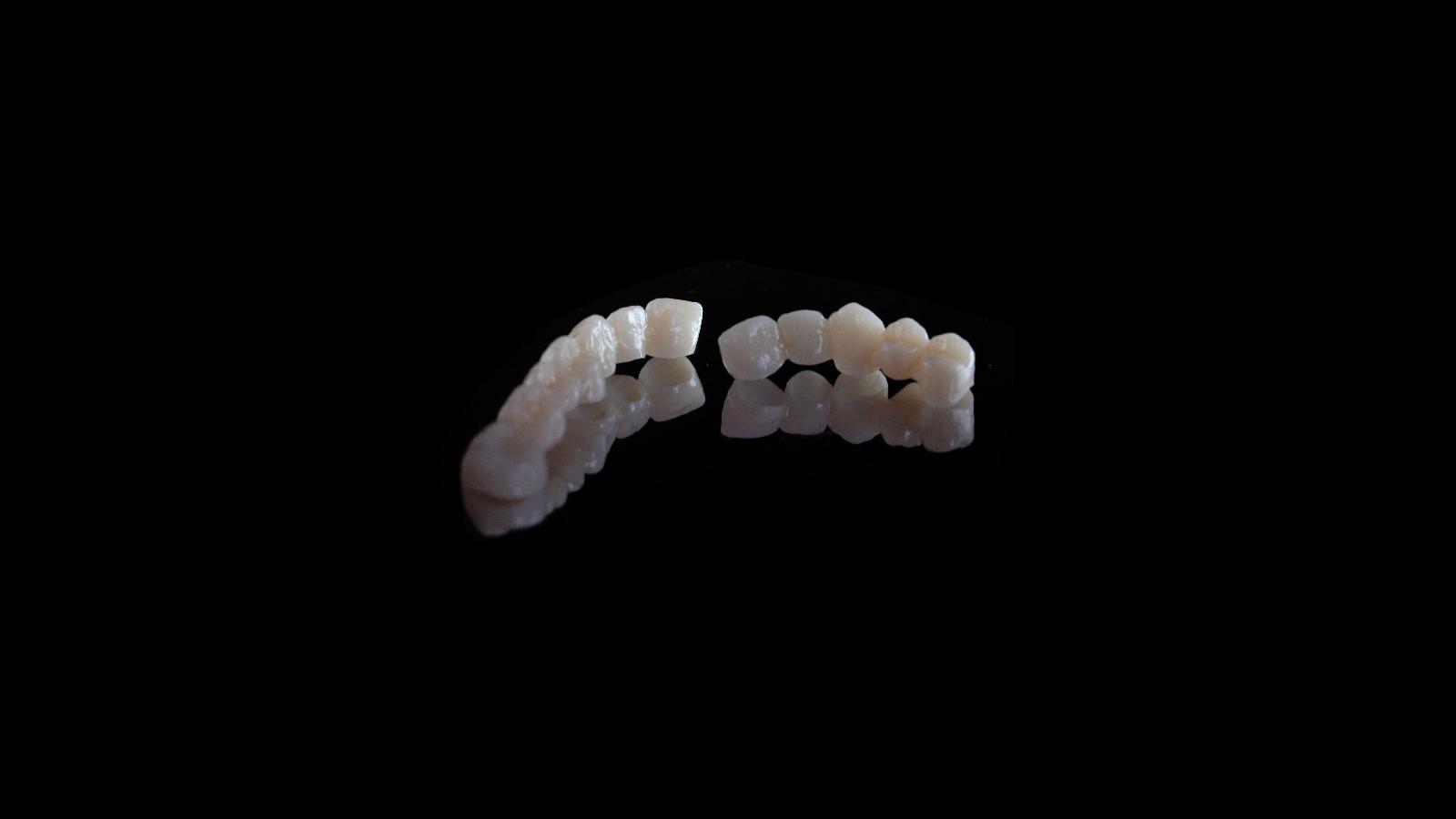 Металлокерамика зубы